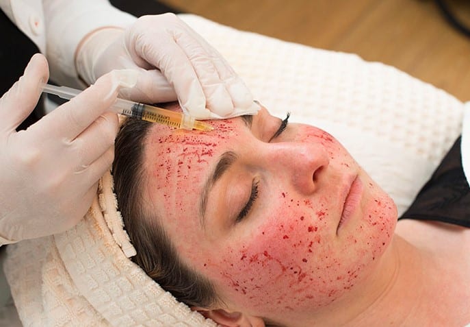 Vampire Facial